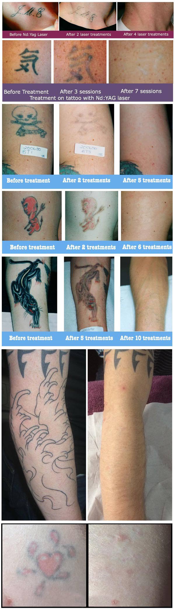 Laser Tattoo Removal Results Gallery  EradiTatt